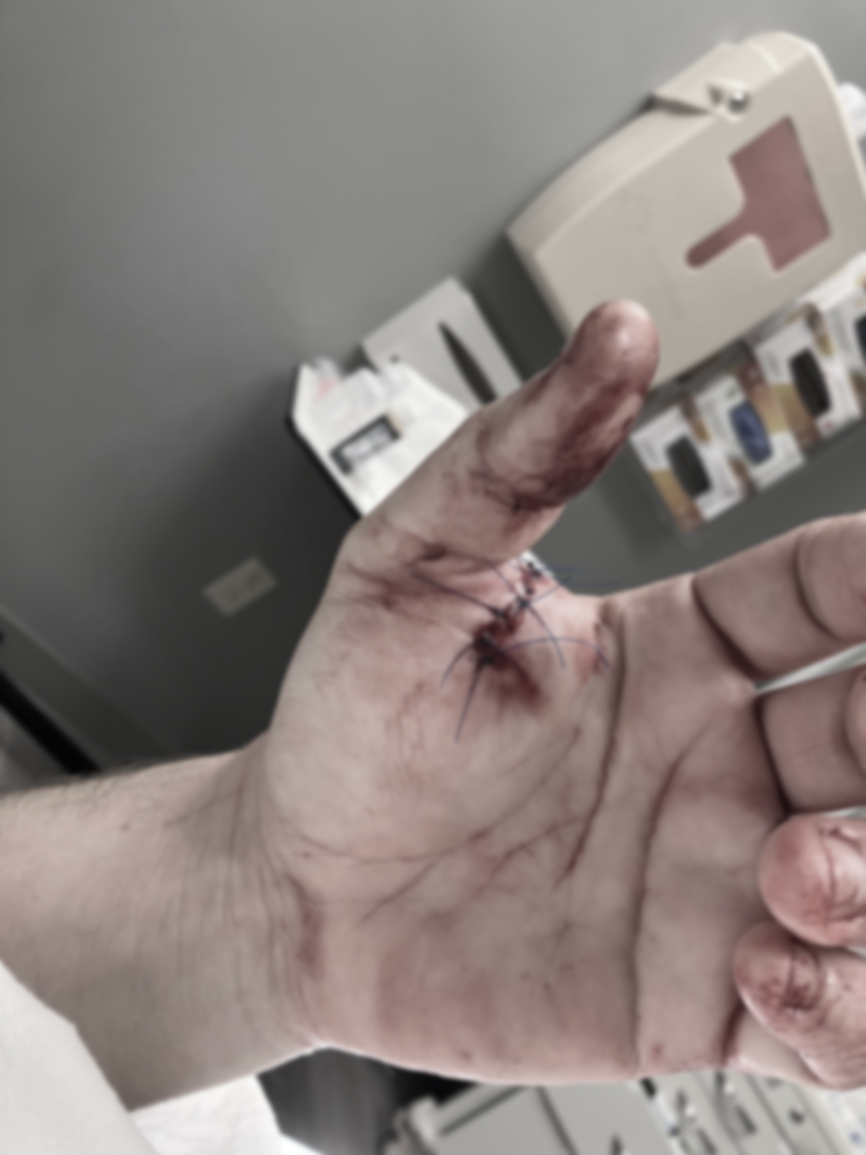 Injury